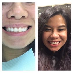 Westwood Family Dental - Love love my results!!