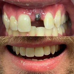 Bristol Dental & Orthodontics - Single implant placement and restoration