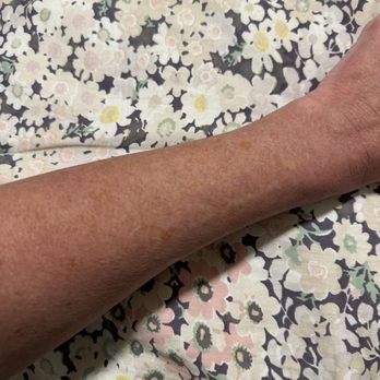 Microbae - Scar camouflage on arms. - Permanent Makeup Near Me - Seattle, Washington Microbae - Scar camouflage on arms. - Permanent Makeup Near Me - Seattle, Washington