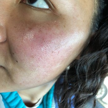 Massage Heights - You can see the micro tears in this one - Skin Care Near Me - Indianapolis, Indiana