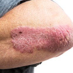 Millcreek Rheumatology - Dermatologists are not always the first medical professionals that come to mind when we think of autoimmune diseases.