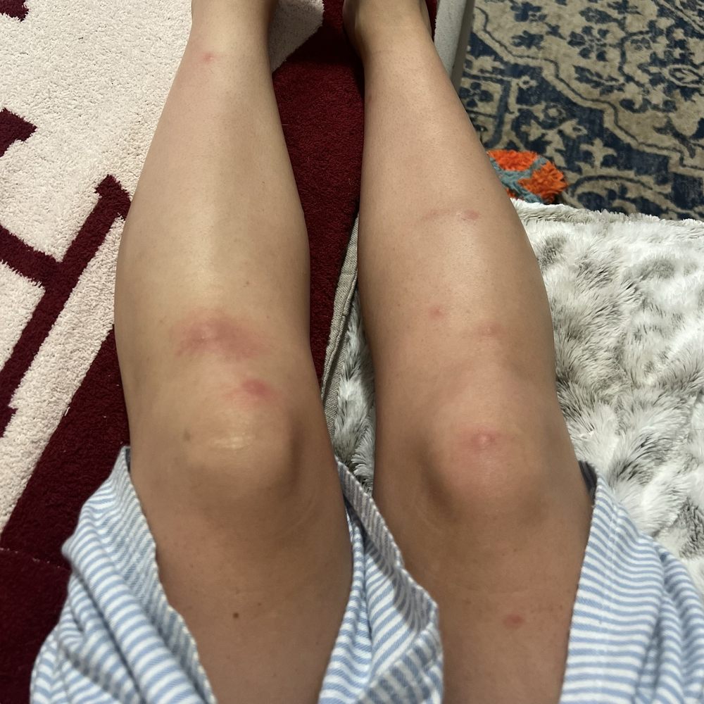 Hillside Ranch - Pic of my legs for reference with the infestation - Apartments Near Me - San Marcos, Texas