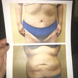 Prima Center Plastic Surgery - My before and after photo of my tummy tuck done by Dr.Song!
He knows what he is doing! I mean he did go to Harvard!