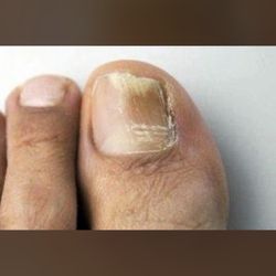 SF Fungal Nail Treatment Clinic