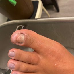 Nail fungus Nail fungus