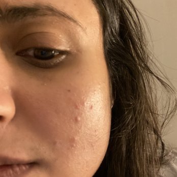 InjectAbility Clinic - 11/24/19 - Skin Care Near Me - Torrance, California