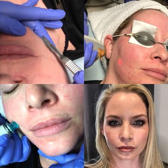 Vitalize Medical Spa - "Spa Day" - Dermaplaning, Laser Genesis, HydraFacial and Make Up by Jessica - Medical Spas Near Me - Plano, Texas