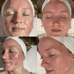 Beauty By Victoria - Before and after pictures of actual Face Reality treatments by Victoria.