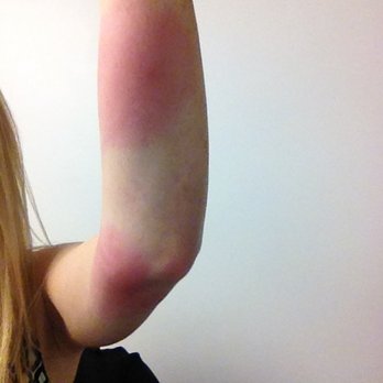 The Parc Hotel - Allergic reaction to bites from bed bug on 11/2/2016 room 908 - Hotels Near Me - Flushing, New York