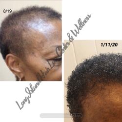 Long Island Hair Loss Center & Wellness - Before & After