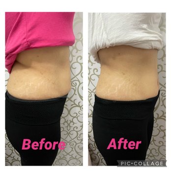 Shape Shifter - Body Contouring Near Me Shape Shifter - Body Contouring Near Me