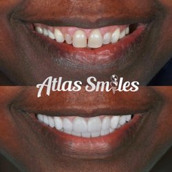 Atlas Smiles