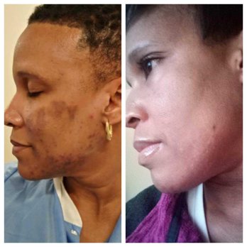 Raw Rituale Med Spa - The picture to your left is before I met Audrey. The picture to the right is after receiving skin care treatment. - Laser Hair Removal Near Me - Denver, Colorado