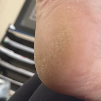 Heavenly Nails Spa - Thick calluses - Skin Care Near Me - Santa Ana, California Heavenly Nails Spa - Thick calluses - Skin Care Near Me - Santa Ana, California