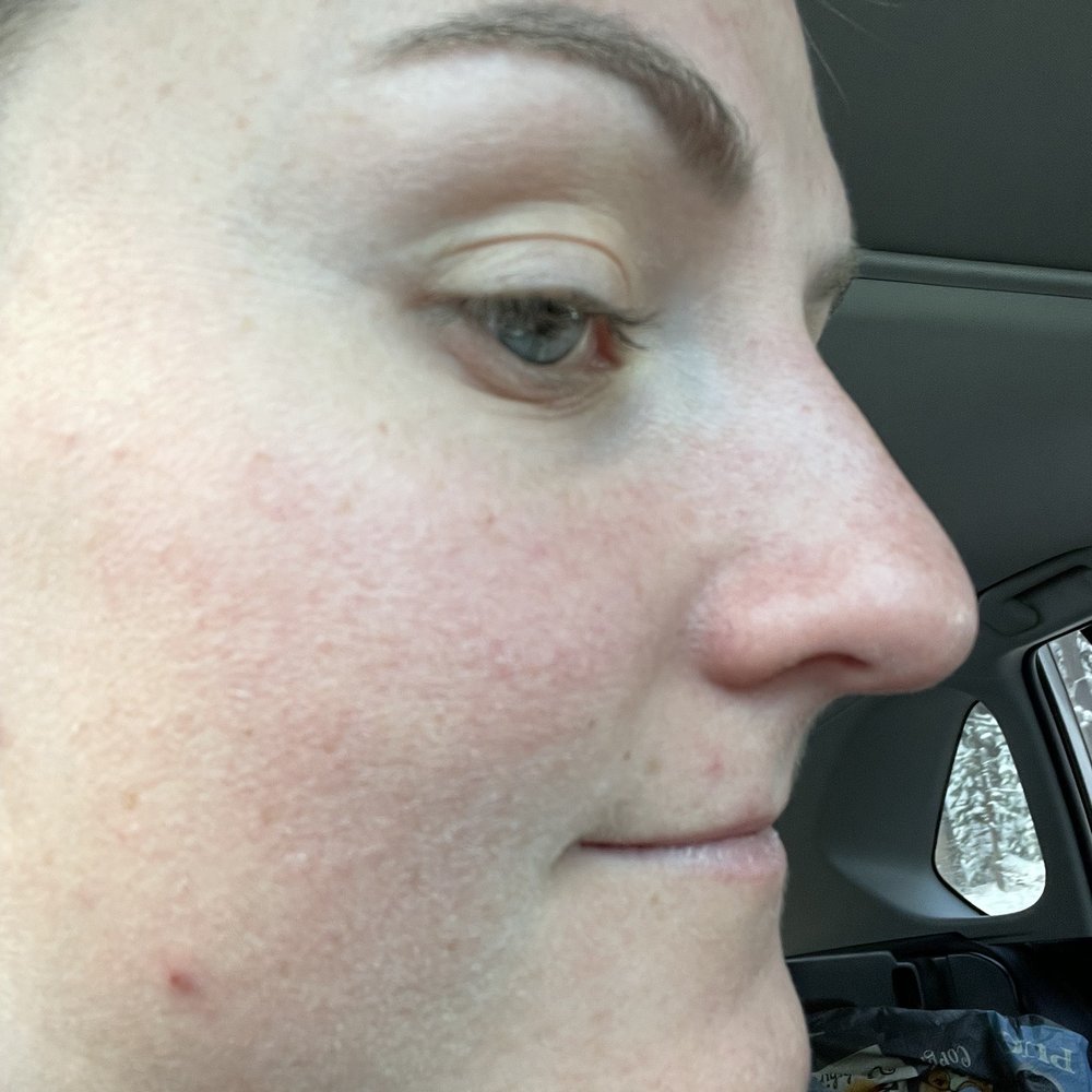 Jeffrey Watson, MD - Day of surgery side profile (before) - Cosmetic Surgeons Near Me - Truckee, California Jeffrey Watson, MD - Day of surgery side profile (before) - Cosmetic Surgeons Near Me - Truckee, California