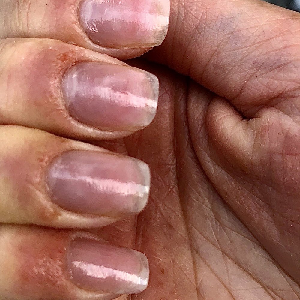 Severe skin trauma from manicure
