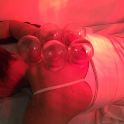 Yangs Acupuncture and Herbal Center - Cupping (cure for a chest cold this time )