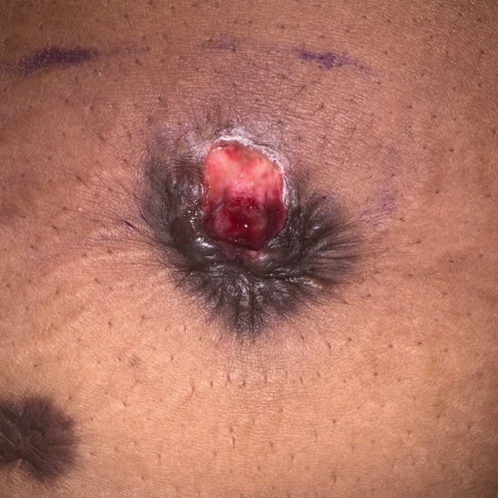 The Cosmetic Concierge - belly button removel - Medical Spas Near Me - Charlotte, North Carolina The Cosmetic Concierge - belly button removel - Medical Spas Near Me - Charlotte, North Carolina