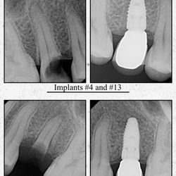 Implants Before and After