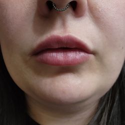 Vesta Aesthetics - Lip filler