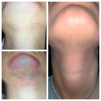 Serene Max - Laser Hair Removal Near Me - New York, New York