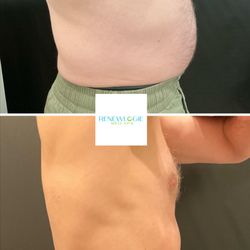 Renewlogie Med Spa - EmsculptNEO transformation at Renewlogie. Patient completed series of 10.