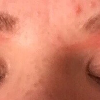 Shyla Nails & Spa - This was the morning after. I'm just hoping it does not scar. - Nail Salons Near Me - Woodbridge, Virginia Shyla Nails & Spa - This was the morning after. I'm just hoping it does not scar. - Nail Salons Near Me - Woodbridge, Virginia