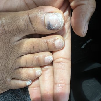 Nail First - Fungus - Nail Salons Near Me - Atlanta, Georgia