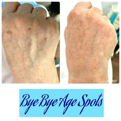 North Star Esthetics  - Let us bring youth back to your hands by treating age/sun/liver spots with the Skin Classic Treatment!