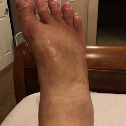 Saleem A Waraich, MD - Severe dactylitis (swollen red toes). The other foot looks like the mirror image of this one! Pathognomonic for psoriatic arthritis.