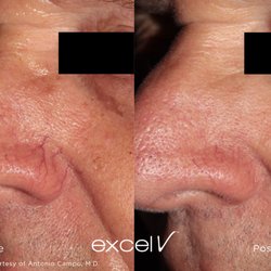 Atlanta Laser Lofts - Removal of nose veins, Spider Veins, broken blood vessels of face