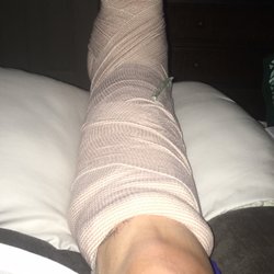 David Nilsen, DO - This is my leg after having a plate and 9 screws installed to help my broken fibula. It was a spiral brea.!