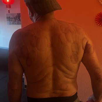 Reno Oriental Massage - Cupping is a must. - Massage Therapy Near Me - Reno, Nevada Reno Oriental Massage - Cupping is a must. - Massage Therapy Near Me - Reno, Nevada