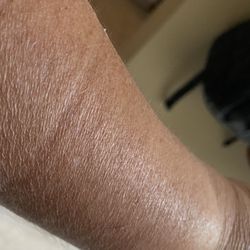 Quest Diagnostics - Swollen arm with mark from tightly wound up elastic band!