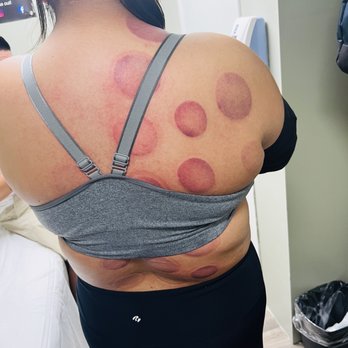 Definition Sports Therapy- Glendora - Cupping, included with our membership - Cryotherapy Near Me - Glendora, California Definition Sports Therapy- Glendora - Cupping, included with our membership - Cryotherapy Near Me - Glendora, California