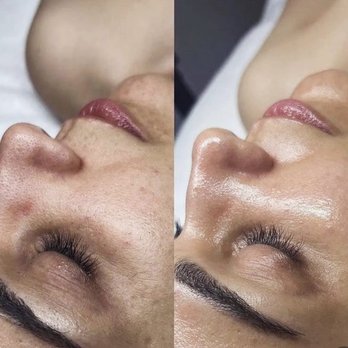 Nedmetics - Acne Treatment Near Me Nedmetics - Acne Treatment Near Me