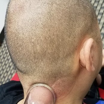 Yin Yang Acupuncture - Cupping on my neck - Acupuncture Near Me - Houston, Texas Yin Yang Acupuncture - Cupping on my neck - Acupuncture Near Me - Houston, Texas