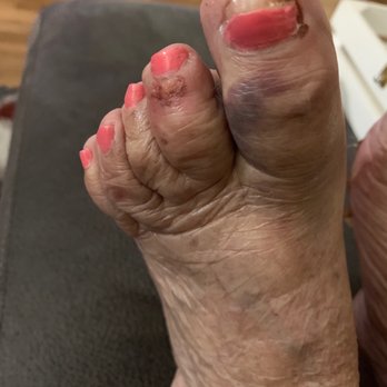 Totally Nails Salon - Poor botched pedicure - Nail Salons Near Me - Port St. Lucie, Florida Totally Nails Salon - Poor botched pedicure - Nail Salons Near Me - Port St. Lucie, Florida