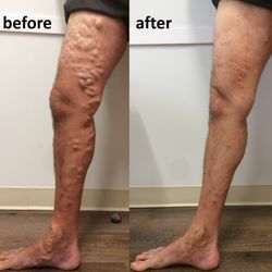 Albert Malvehy, MD - NorCal Vein Specialists - Varicose veins removal
laser vein treatment