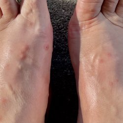 Clarion Hotel Beachfront - Flea bites