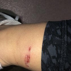 Nails First - Infection