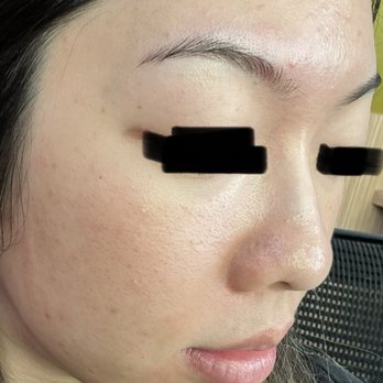 NakedMD - Bad microneedling resulting in enlarged pores, hyperpigmentation, blotchy and sensitive skin - Medical Spas Near Me - Anaheim, California