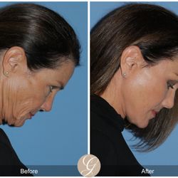 Kevin Sadati - Deep Plane Facelift Deep Plane Neck Lift
Quad Blepharoplasty
Full Face CO2 Laser Resurfacing
Temporal Brow Lift