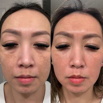 Glow DermSolutions - Cosmelan treatment with Laura at Glow DermSolution - Medical Spas Near Me - San Jose, California Glow DermSolutions - Cosmelan treatment with Laura at Glow DermSolution - Medical Spas Near Me - San Jose, California