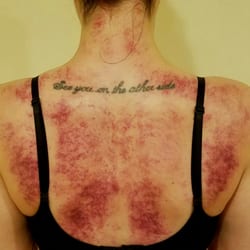 Gua Sha and Cupping treatment by Chen Chen...I feel light and loose!