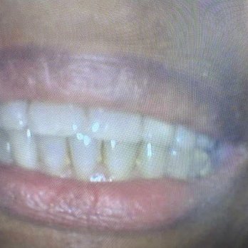 Downey Modern Dentistry - Before - General Dentistry Near Me - Downey, California