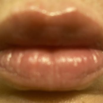 Plump Lip Love - After restalyne - Medical Spas Near Me Plump Lip Love - After restalyne - Medical Spas Near Me