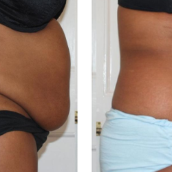 Strawberry Laser Lipo of Kissimmee