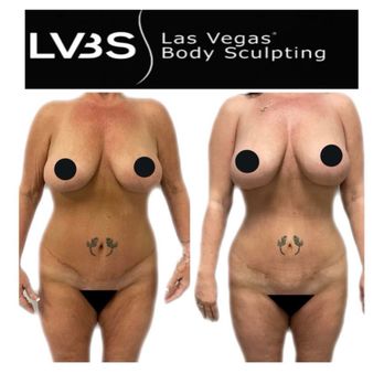 Las Vegas Body Sculpting - Medical Spas Near Me - Henderson, Nevada