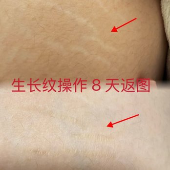 Lai PMU Beauty - Stretch marks inkless Before & After - Permanent Makeup Near Me - Arcadia, California Lai PMU Beauty - Stretch marks inkless Before & After - Permanent Makeup Near Me - Arcadia, California